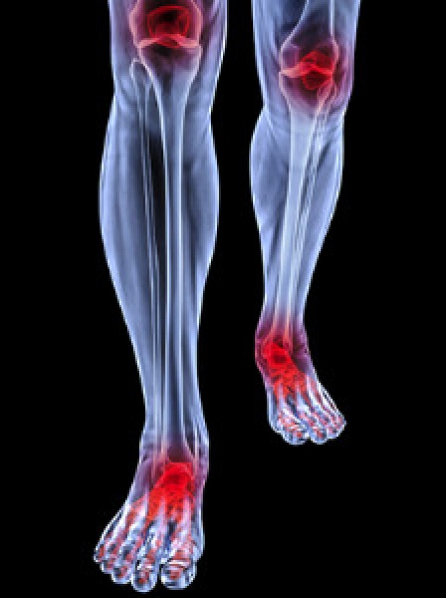 How Rheumatoid Arthritis Can Affect the Feet