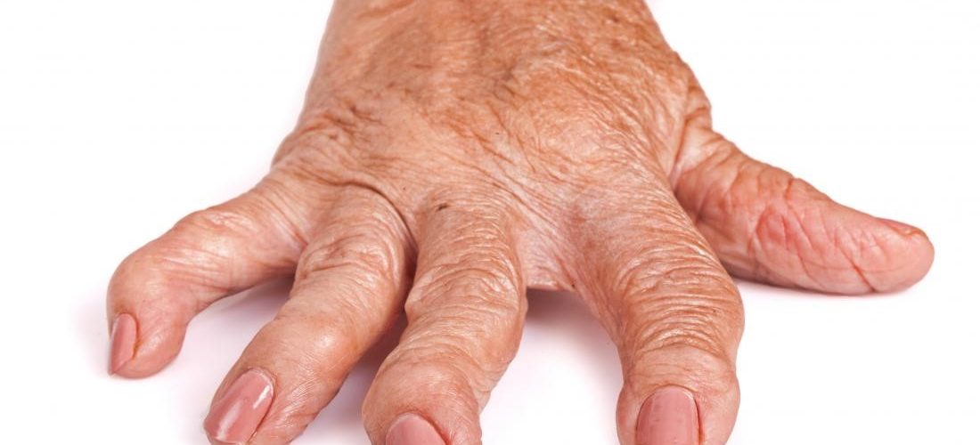 How Serious Is Rheumatoid Arthritis