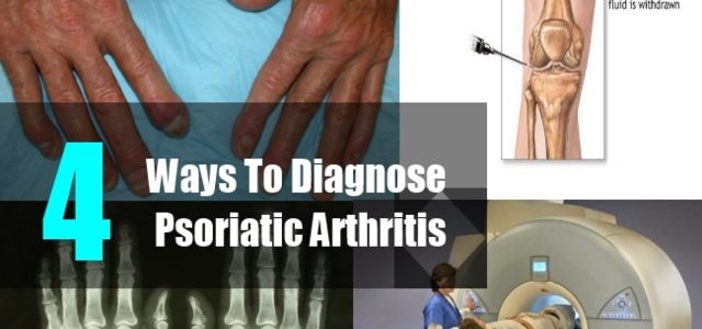 How To Diagnose Psoriatic Arthritis