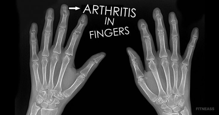 How To Get Rid Of Arthritis In Fingers With A Therapy Ball ...