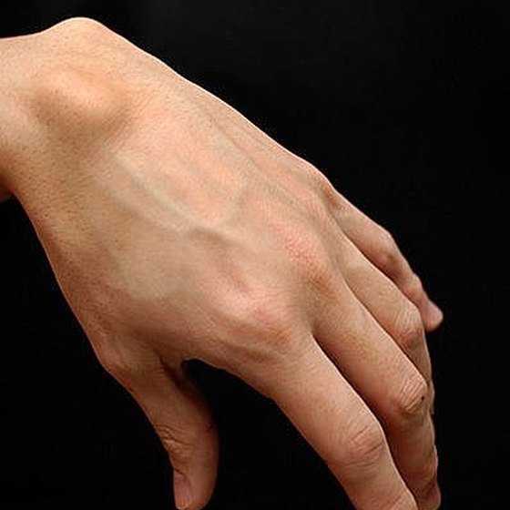 How to Know if Hand or Wrist Pain is a Ganglion Cyst