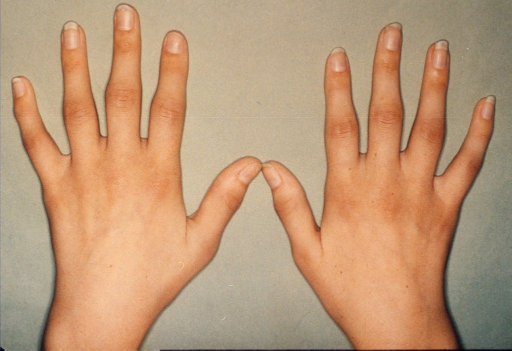 How to Prevent Arthritis in Fingers