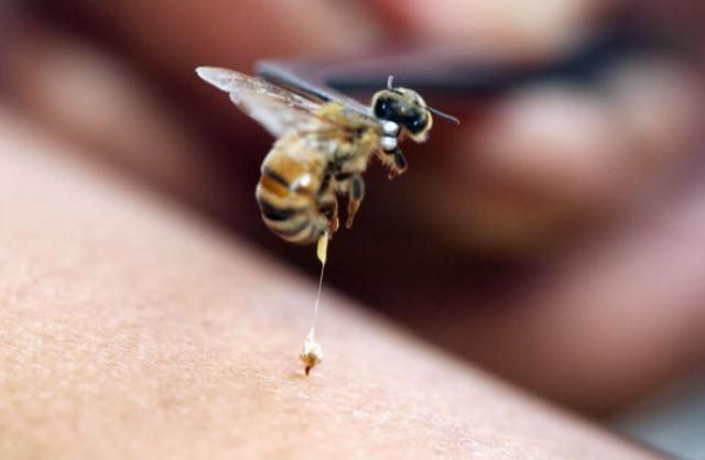 How to Remove a Bee Stinger in the Skin