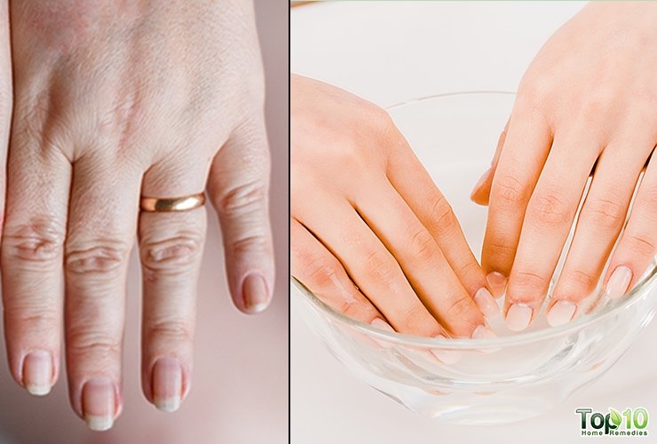 How to Treat Swollen Fingers