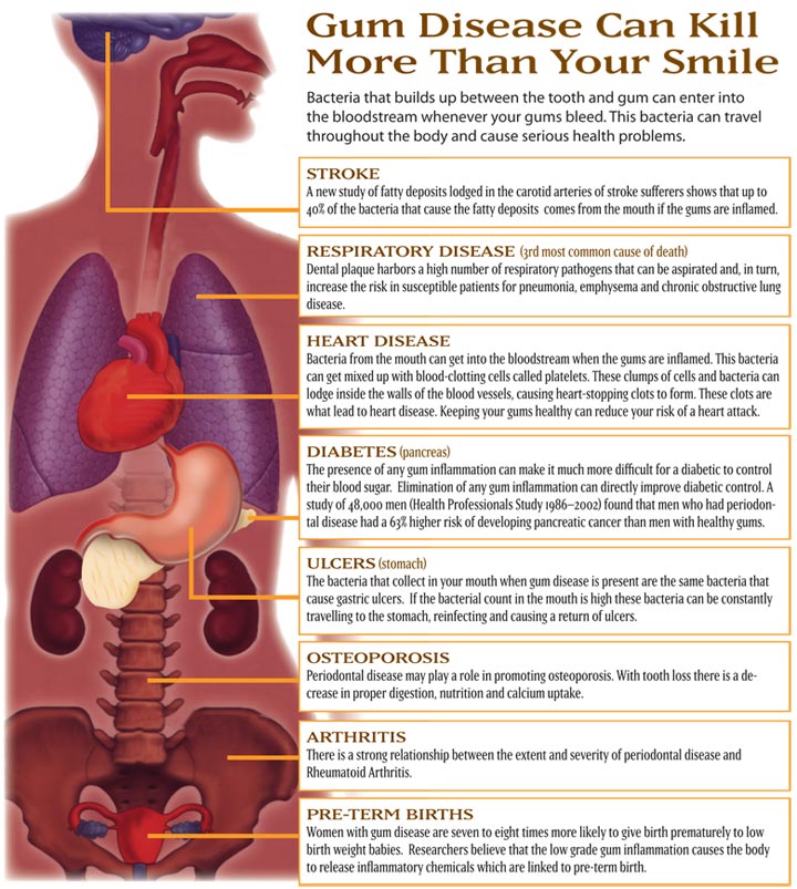 Hypertension And Oral Health