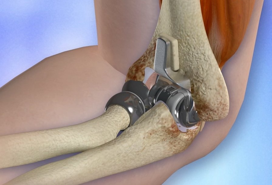 I Have Bad Rheumatoid Arthritis of the Elbow: How Good Are ...