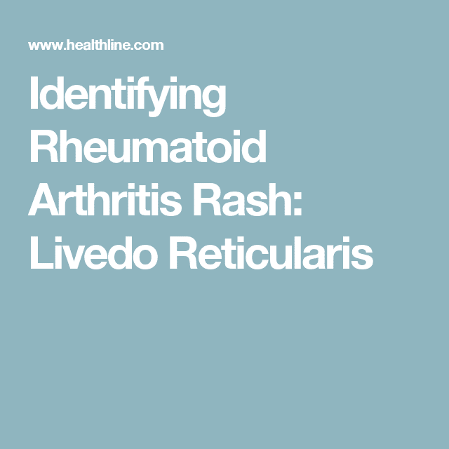Identifying Rheumatoid Arthritis Rash: Livedo Reticularis