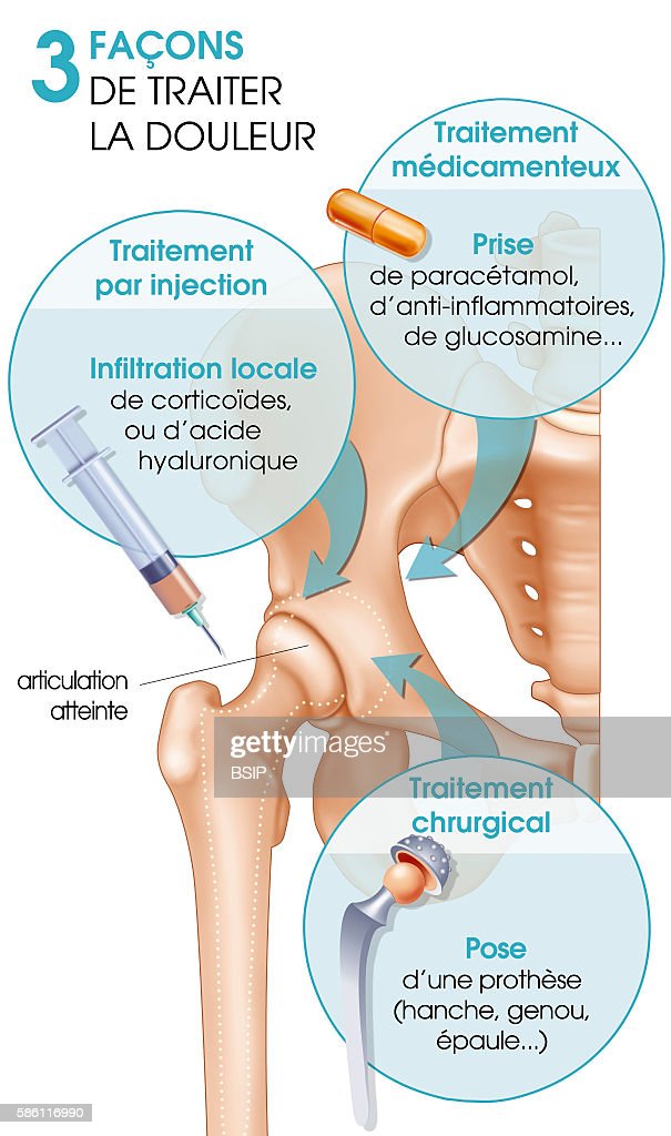 Illustration of the various treatments of joint pain, shown on a hip ...