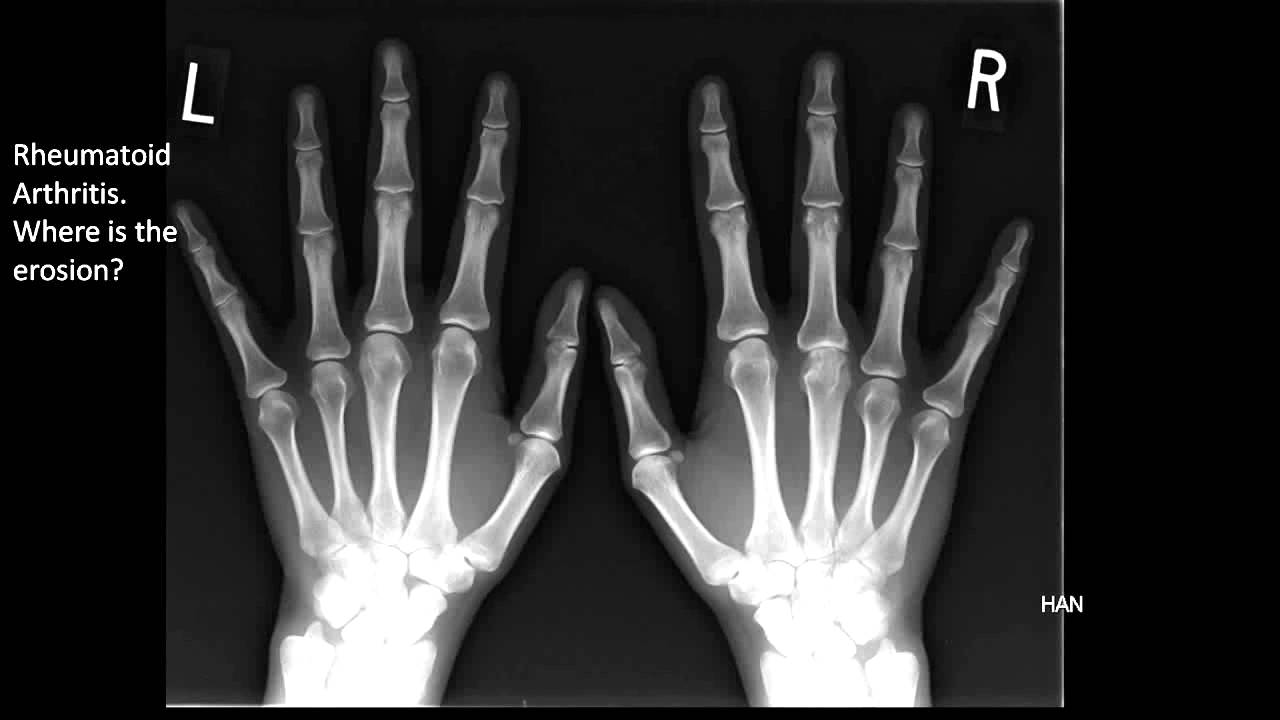 Image of the Month April 2011: Rheumatoid Arthritis X