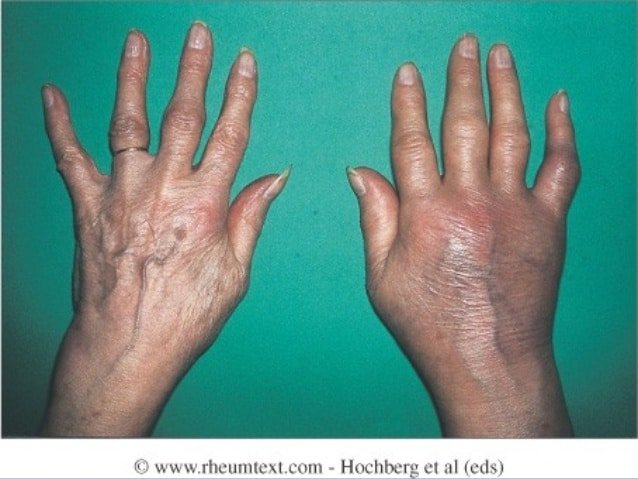 Inflammatory arthritis an overview