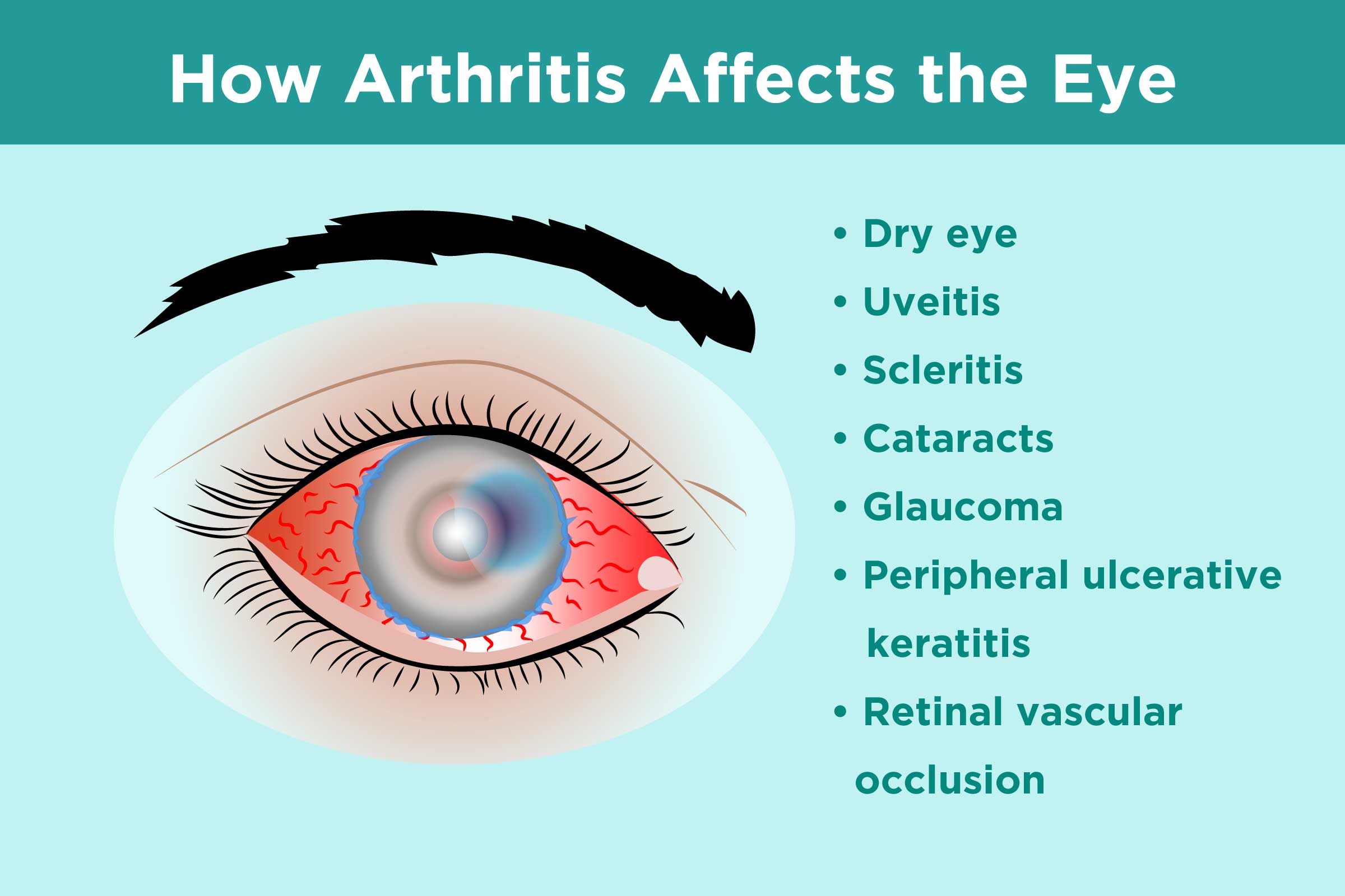 Inflammatory Arthritis and Eye Health: Prevention ...