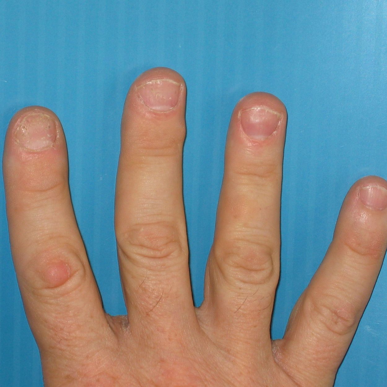 Inflammatory Arthritis Fingernails Nail Art Ideas
