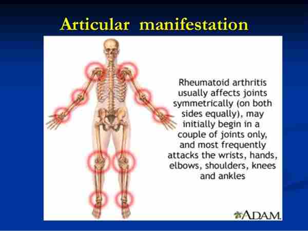 Inflammatory Arthritis In Shoulder Cramps Do Get Muscle ...