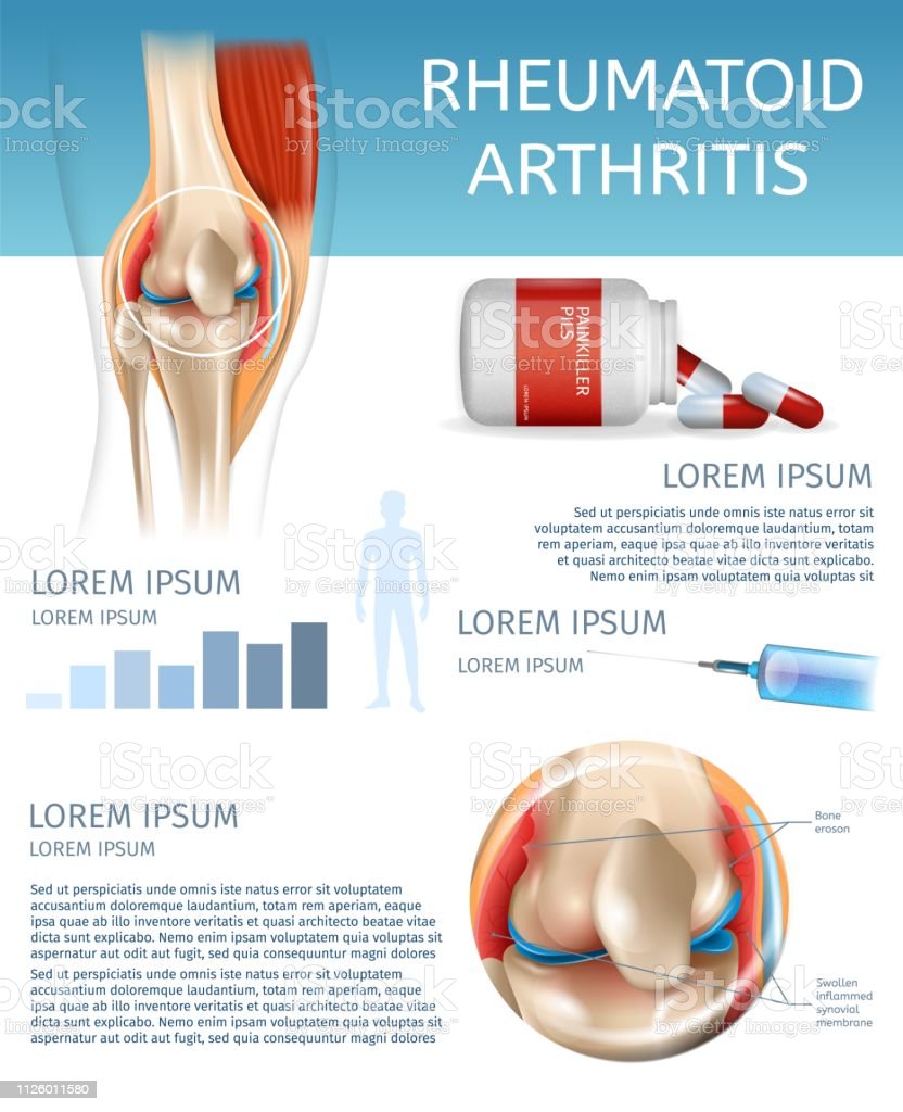 Infographic Treatment Method Rheumatoid Arthritis Stock Illustration ...