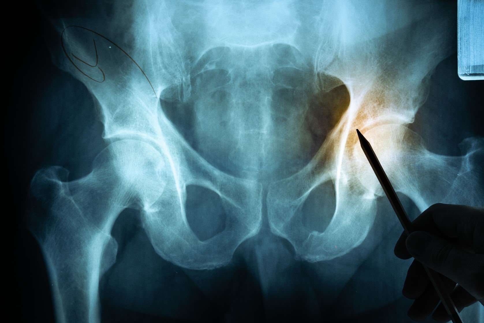 Is It Back Pain or Hip Pain? Getting to the Root of the ...