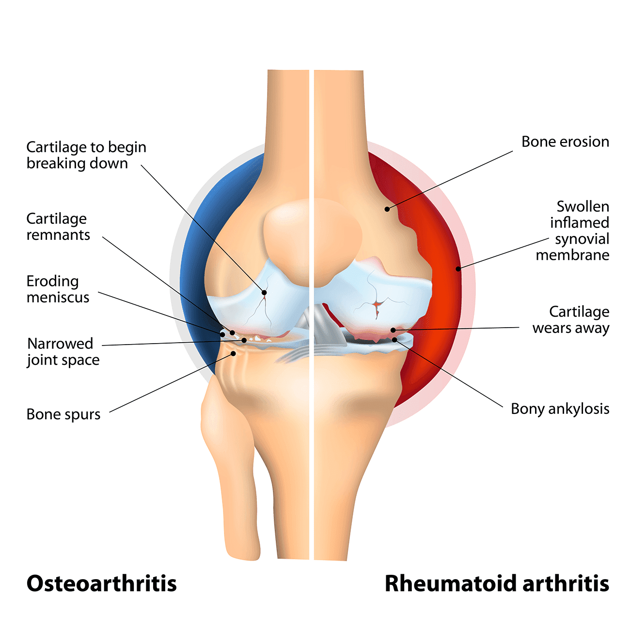 Is Rheumatoid Arthritis More Painful Than Osteoarthritis