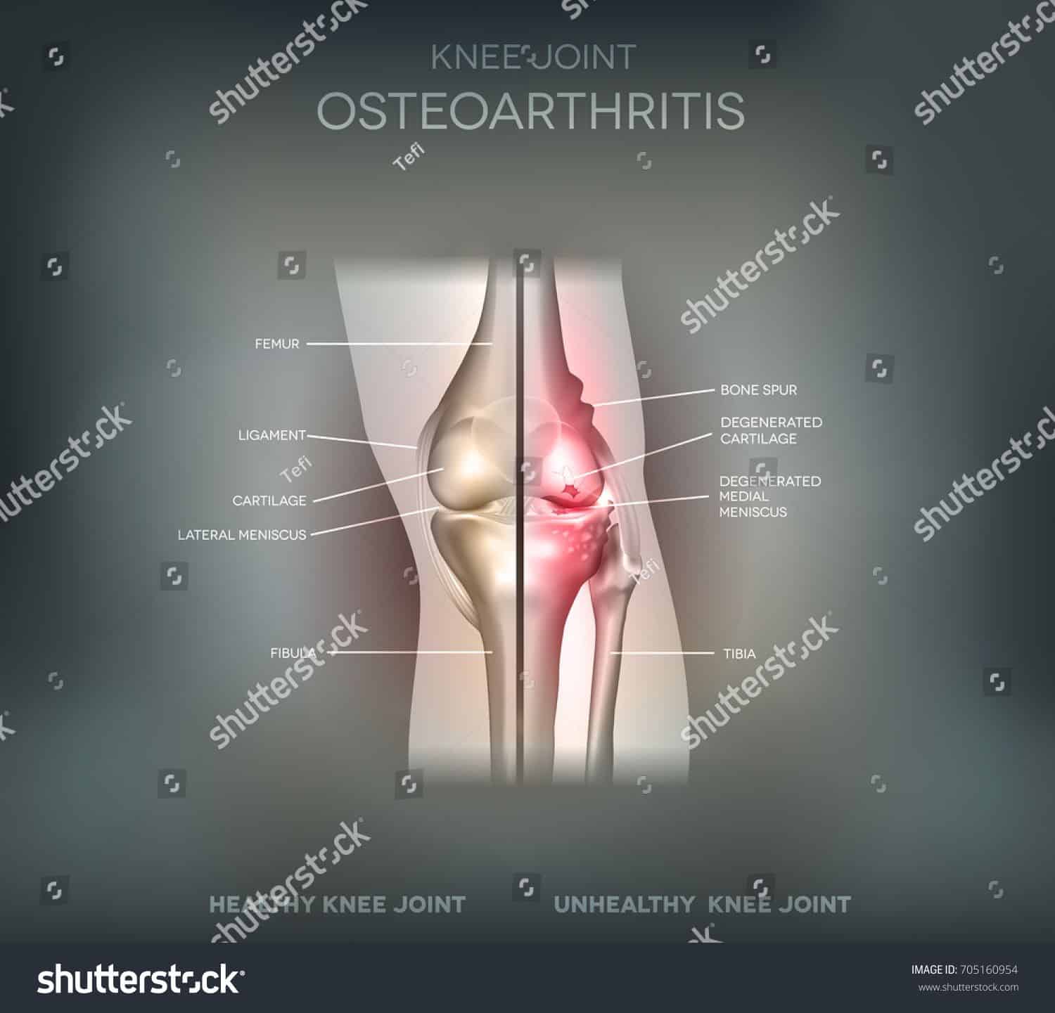 Joint problems osteoarthritis, healthy joint and damaged joint ...