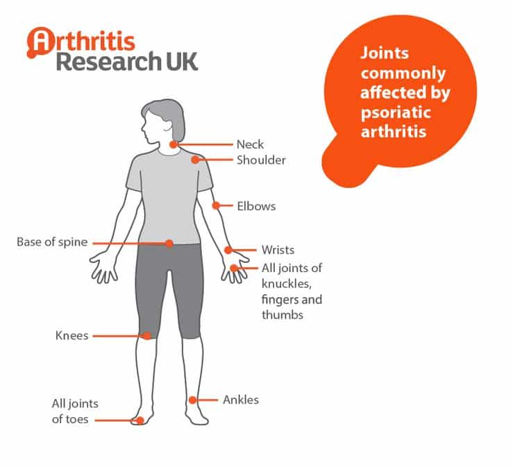 Joints commonly affected by psoriatic arthritis
