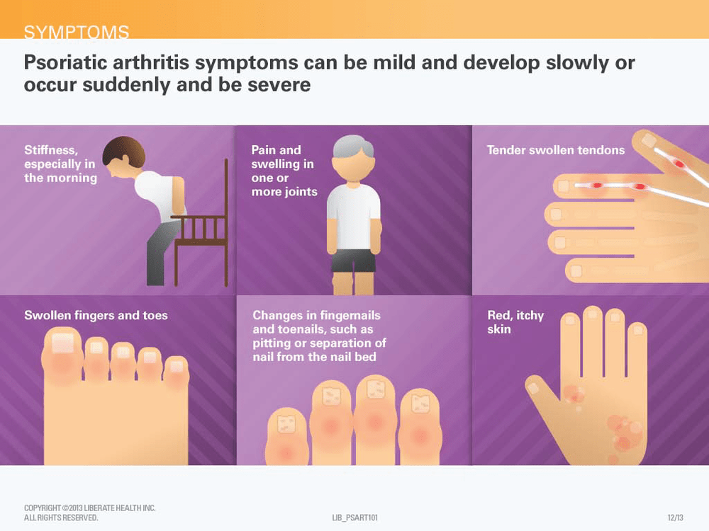 Juvenile Arthritis Treatment With Early Diagnosis ...