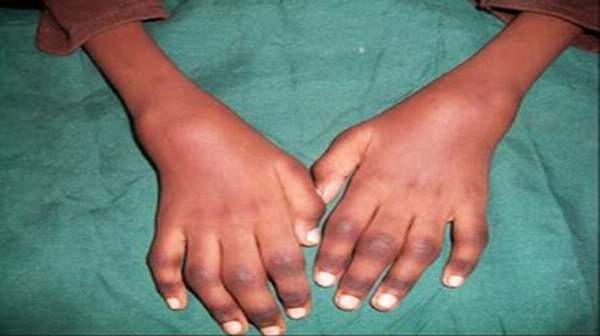Juvenile Rheumatoid Arthritis Causes Persistent Joint Pain