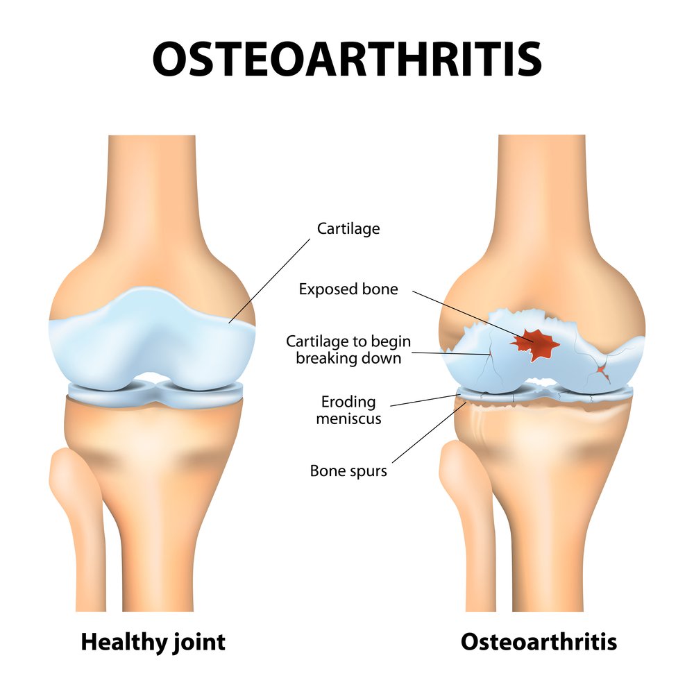 Knee Arthritis Exercises