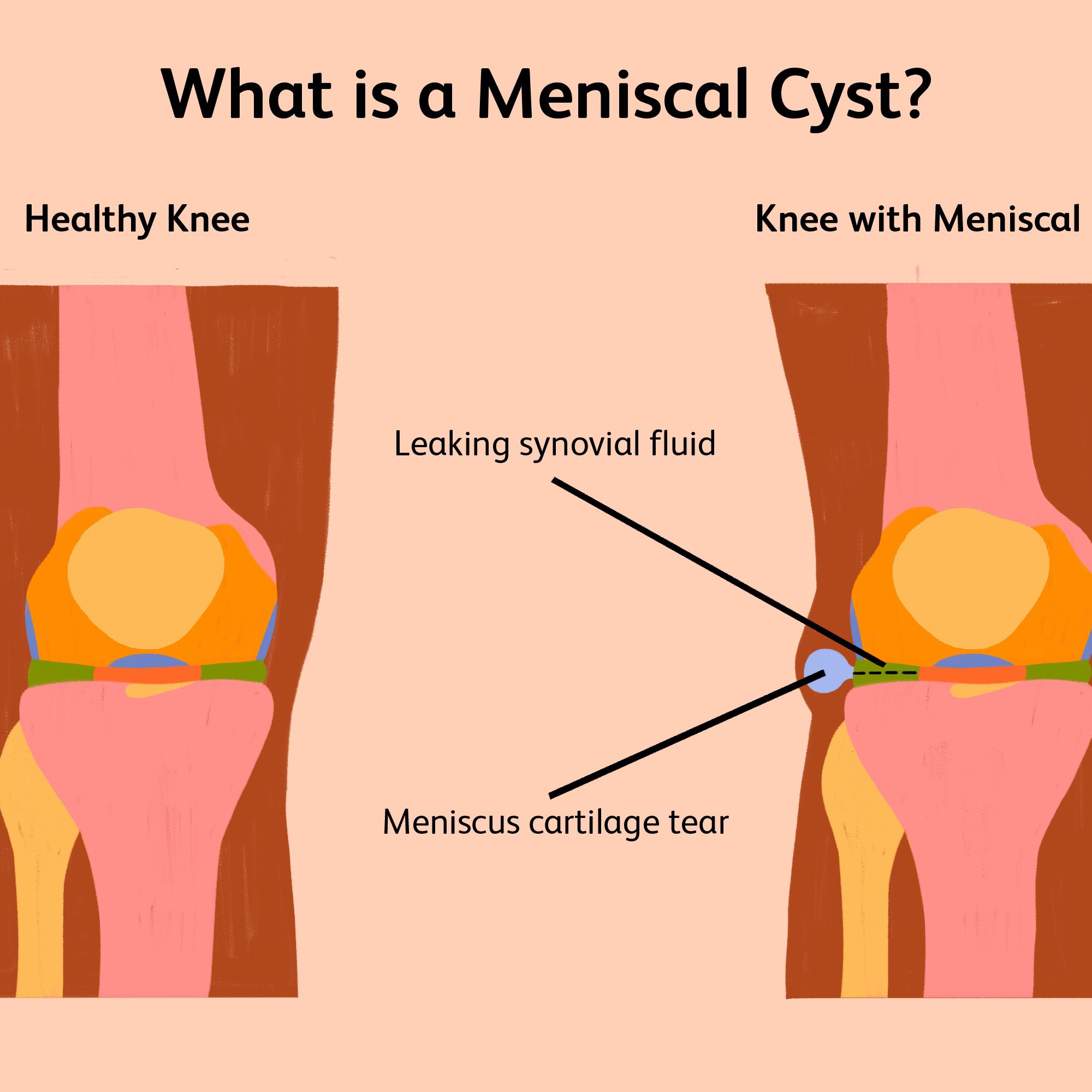 Knee Pain: Causes Symptoms And Treatment Options  Brandon Orthopedics