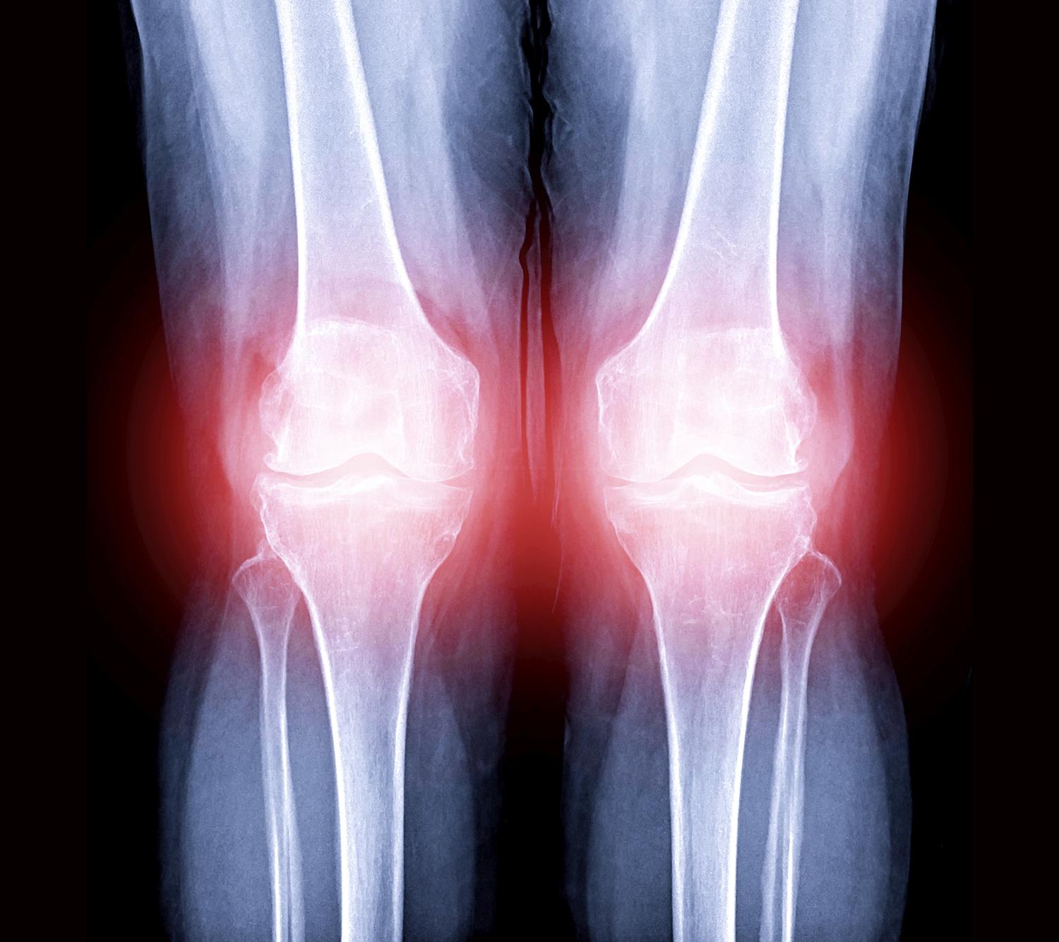 Knee replacement regret: Procedure oversold as solution to ...