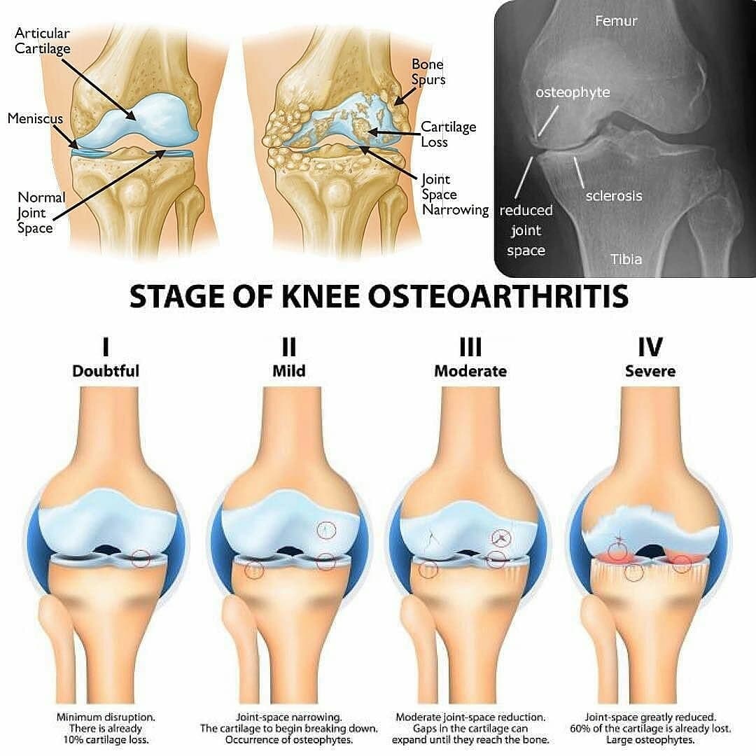 Learning about knee arthritis