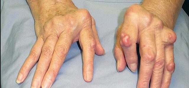 Long Term Effects Of Untreated Rheumatoid Arthritis ...