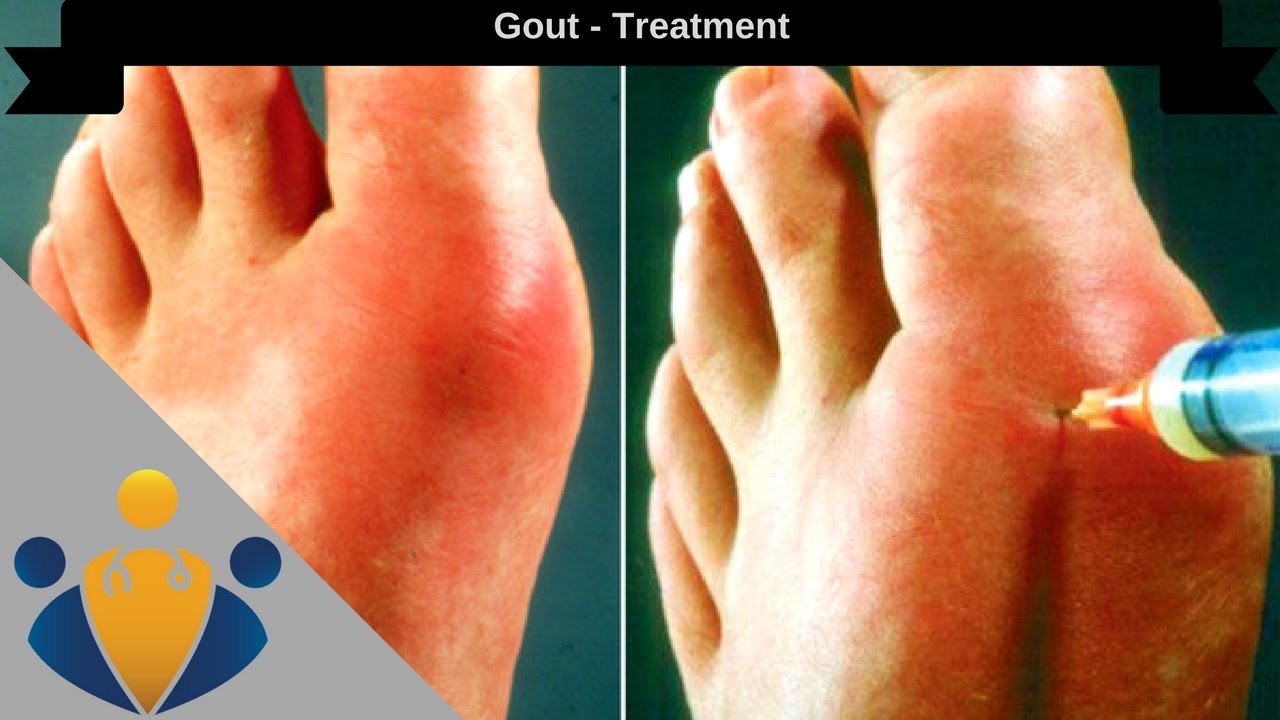 Medicine For Gout
