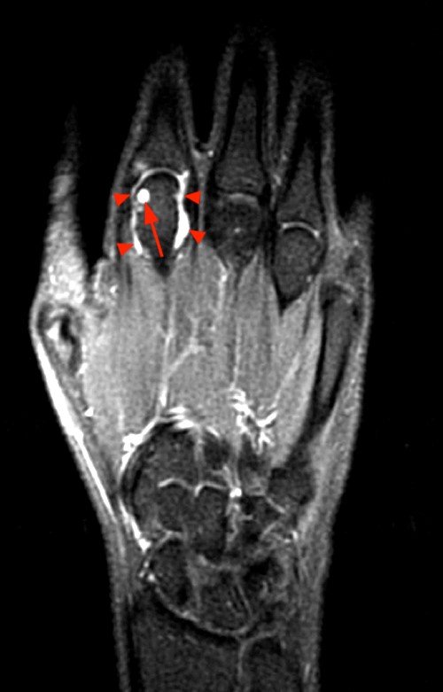 MR Imaging of Rheumatoid Arthritis
