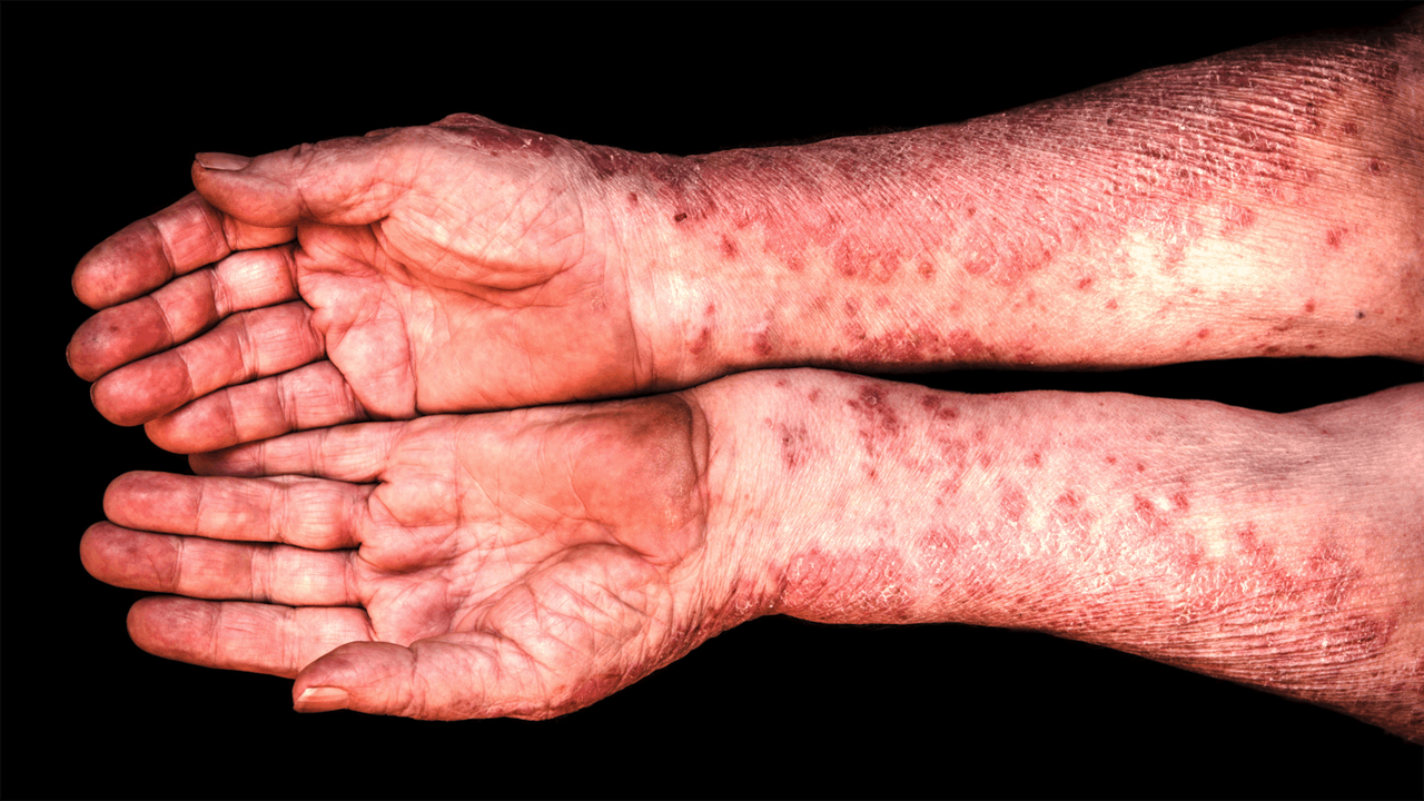 Myths About Psoriatic Arthritis