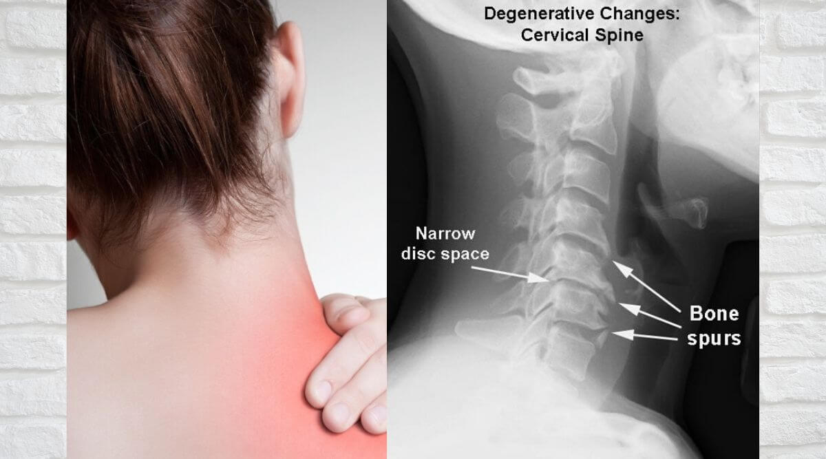 Neck pain: Cervical Spondylosis. What is Spondylosis &  do ...