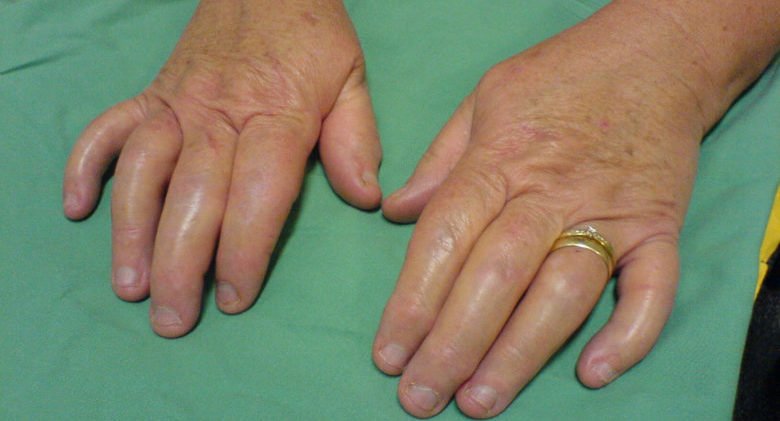 OMG! Do You Have Psoriatic Arthritis? â Page 4 â Life