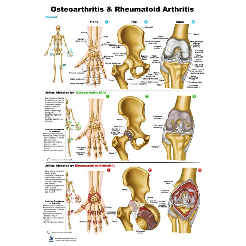 Osteoarthritis and Rheumatoid Arthritis Medium Poster