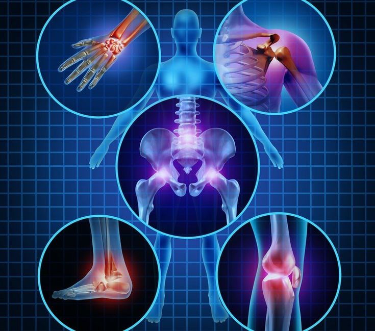 Osteoarthritis: Causes, Risks, Treatments &  Prevention (With images ...