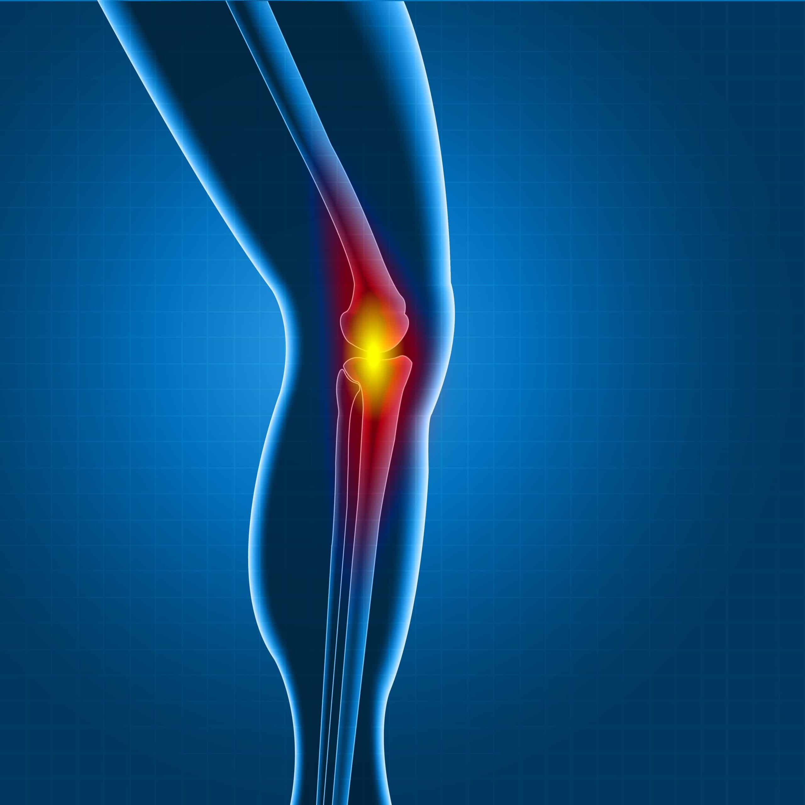 Osteoarthritis: If it doesnât get you in the knees, you may feel it in ...