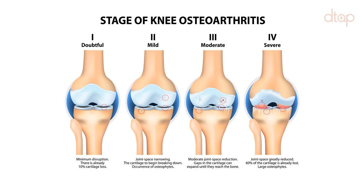 Osteoarthritis Knee (OA)