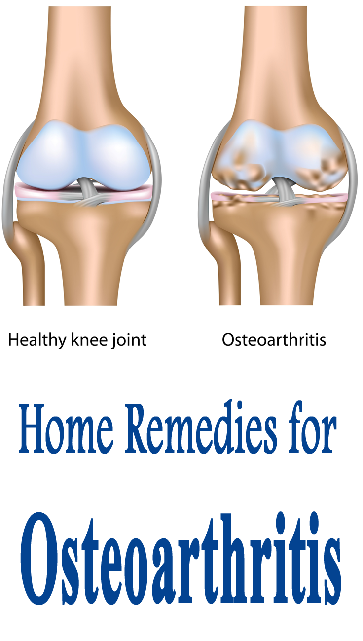 Osteoarthritis (OA), also known as degenerative arthritis is a chronic ...