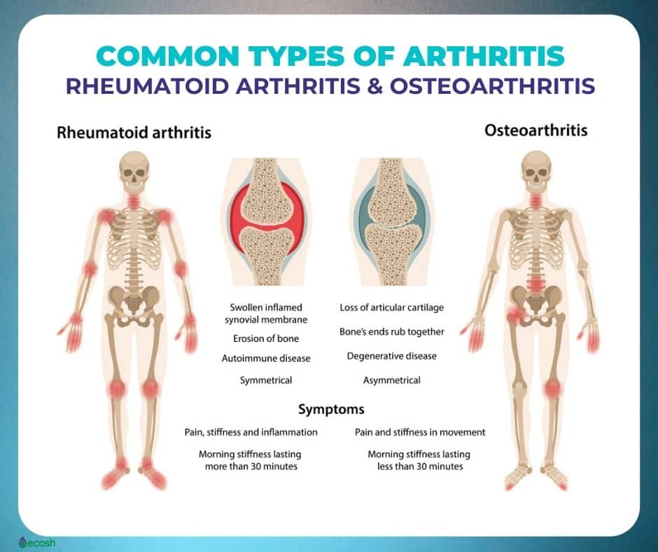 OSTEOARTHRITIS (OA)  Symptoms, Causes, Risk Groups, Prevention and ...