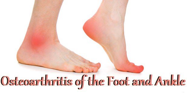 Osteoarthritis of the Ankle. What Is Osteoarthritis? Osteoarthritis ...
