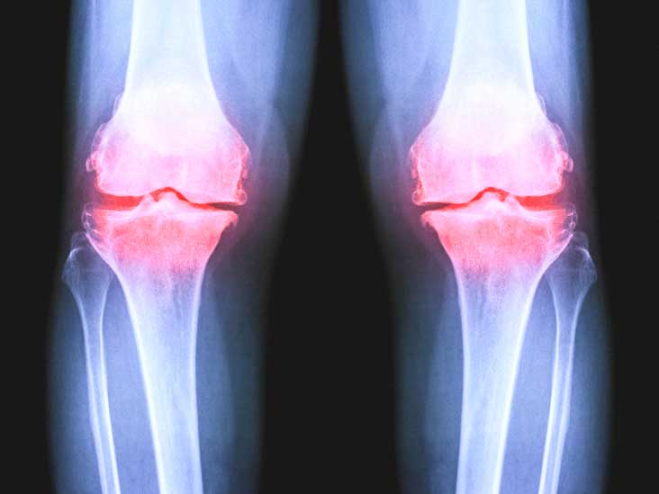 Osteoarthritis of the Knee X