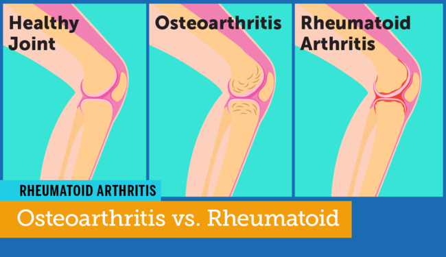 Osteoarthritis vs. Rheumatoid Arthritis: Are They One and ...