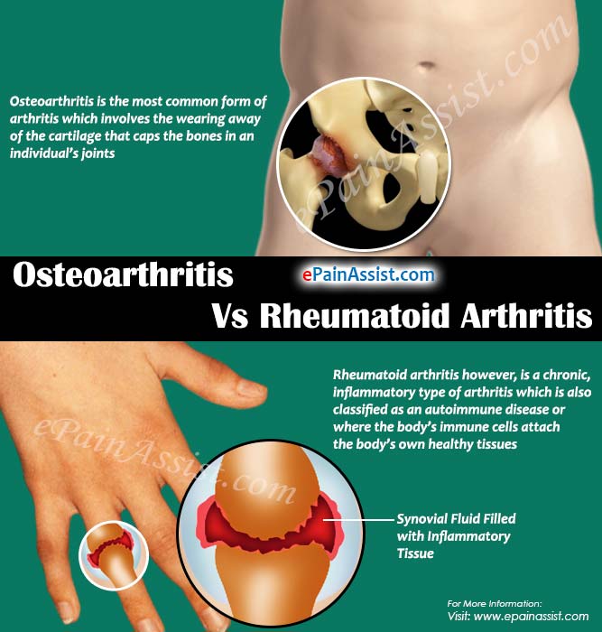 Osteoarthritis Vs Rheumatoid Arthritis: Differences Worth ...