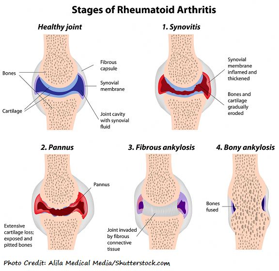 Osteoarthritis vs. Rheumatoid Arthritis NCLEX Review # ...