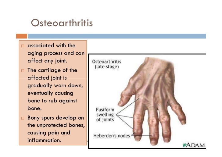 Osteoarthritis vs rheumatoid arthritis ppt