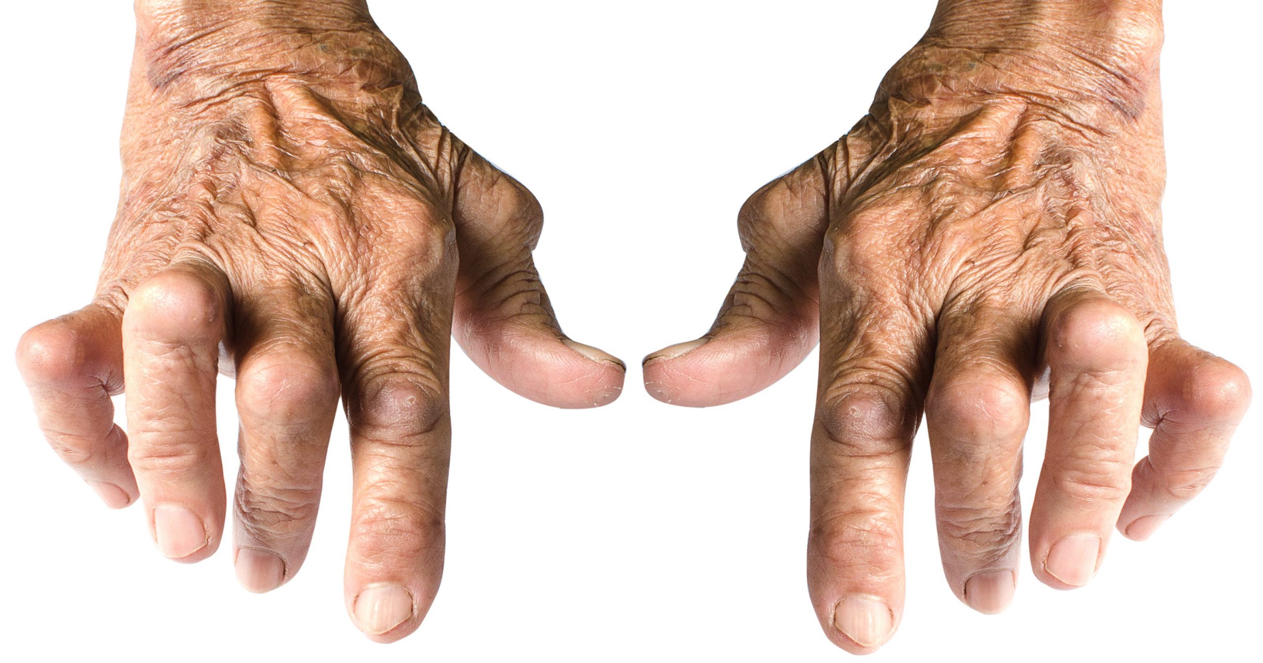Over time, rheumatoid arthritis can lead to deformities
