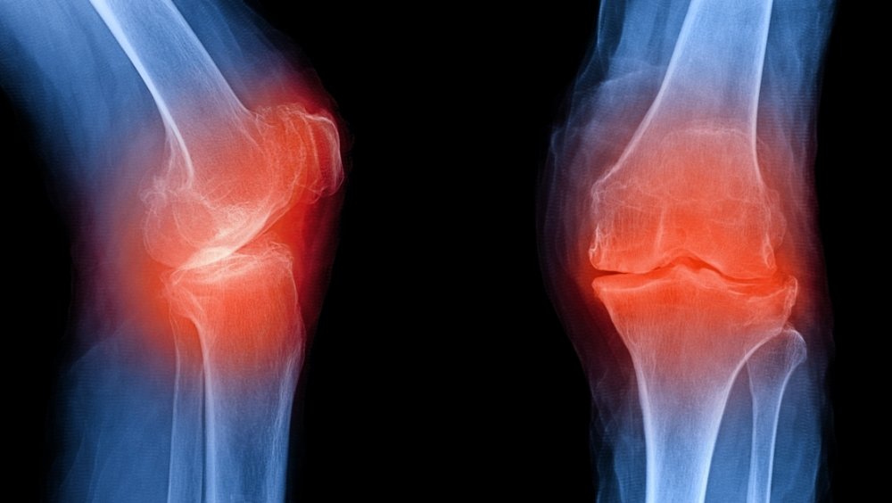 Pain Patterns in Knee Osteoarthritis May Be Associated ...