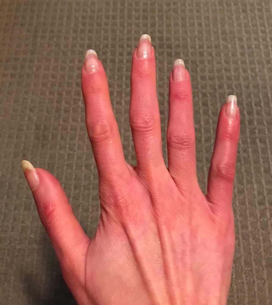 painful, swollen fingers and toes (erythromelalgia/Raynaudâs pain ...