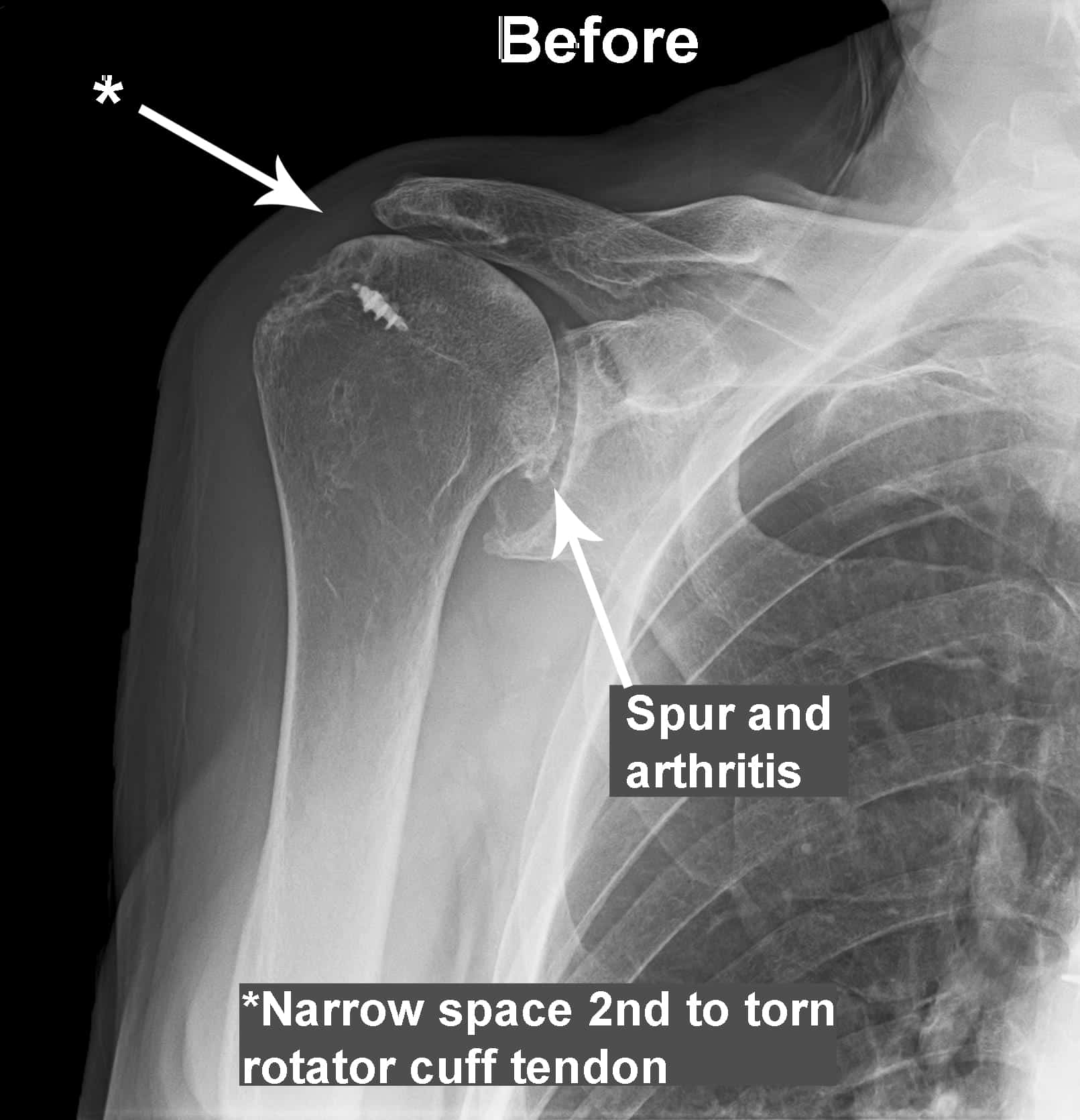 Partial or Total Shoulder Replacement